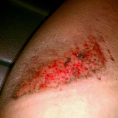 road rash injuries