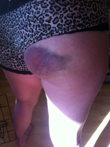Absolutely Scabulous’ bootyful bruise